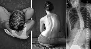 Example of spine deviation, a thoracic scoliosis